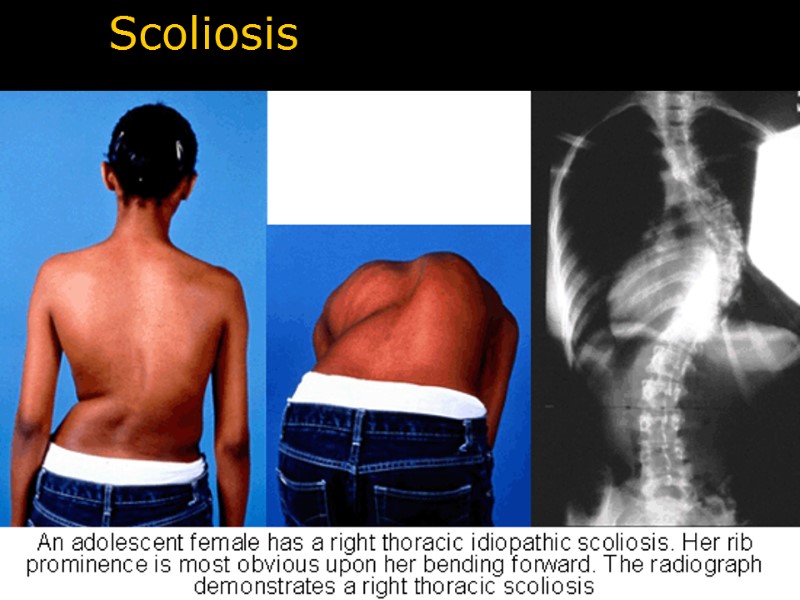 Scoliosis